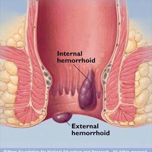 Herbal Cure For Hemorrhoids - Hemorrhoids Remedies: 4 Ways To Relieve Hemorrhoid Pressure