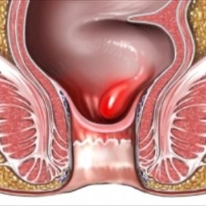 Infant Hemorrhoid - Hemorrhoid Treatment For Ex-Hemorrhoid Patients