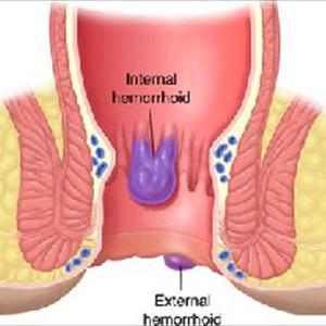 Treating Hemorrhoid - Hemorrhoid Removal Clinics