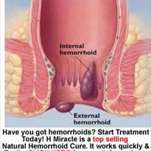 Swollen Hemorrhoids - Hemorrhoid Treatment: Two Basic Types Of Treatment To Choose From