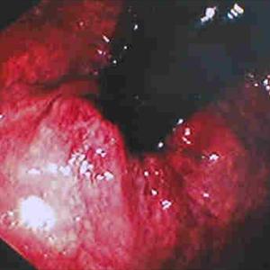 Healing Internal Hemorrhoids - Various Efficient Internal Hemorrhoid Treatment