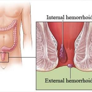 Best Hemorrhoids Cream - Cure Hemorrhoids Naturally And Permanently