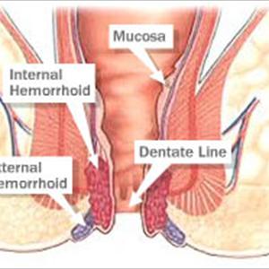 Hemorrhoid Relief Centers - Hemorrhoid Relief - 3 Quick Methods To Getting Hemorrhoid Treatment