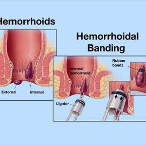 Cure For Hemorrhoid - OTC Hemorrhoid Treatment - How They Work?