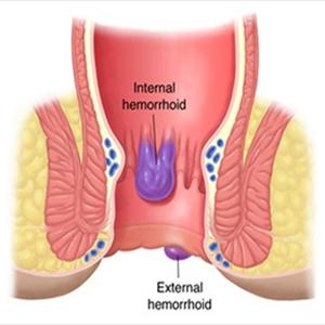 Hemorrhoid Stapling Problems - Internal Hemorrhoid Treatment - How To Remove Internal Piles Quickly And Forever