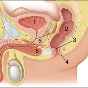 Symptoms Of External Hemorrhoids - Cure For Hemroid - Infrared Coagulation Hemorrhoid - External Hemorrhoid Relief