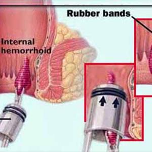 Hemroid Doctors - Hemorrhoid Miracle Review : Cure Hemorrhoid In 48 Hours?