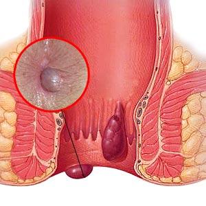 Painful Internal Hemroids - Choose A Hemorrhoid Treatment That