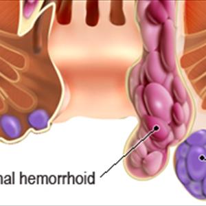 Hemorrhoid Pics - External Hemorrhoid Treatment