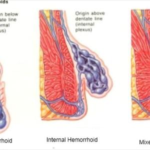 Treatment For Internal Hemorrhoids - Do Hemorrhoid Suppositories Work?