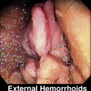 Hemorrhoid Ligation - Natural Hemorrhoid Treatment Is Safer And Cost Effective