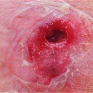 Surgery For Hemorrhoid - Natural Cures For Hemorrhoids To Help Relieve Pain