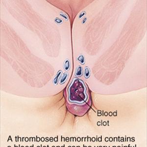 Medical Pictures Of Hemroids - Prevention As A Hemorrhoid Treatment Option